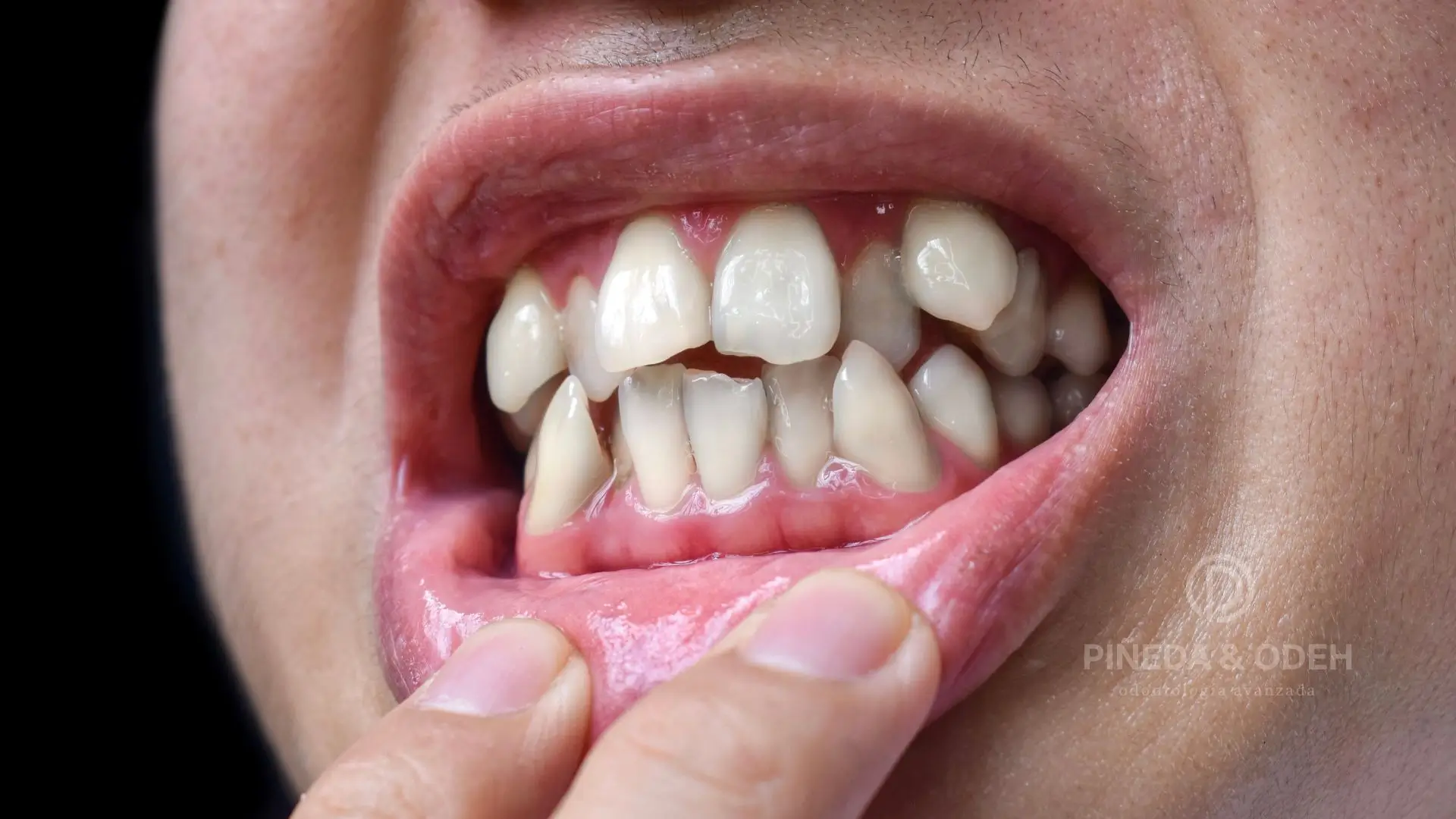 Dientes torcidos y desalineados