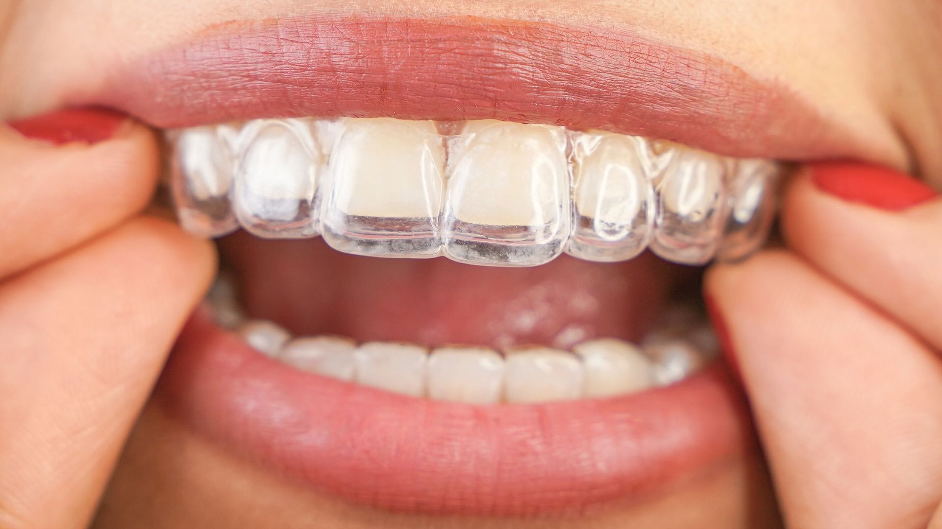 ortodoncia-invisible-en-alcobendas-madrid