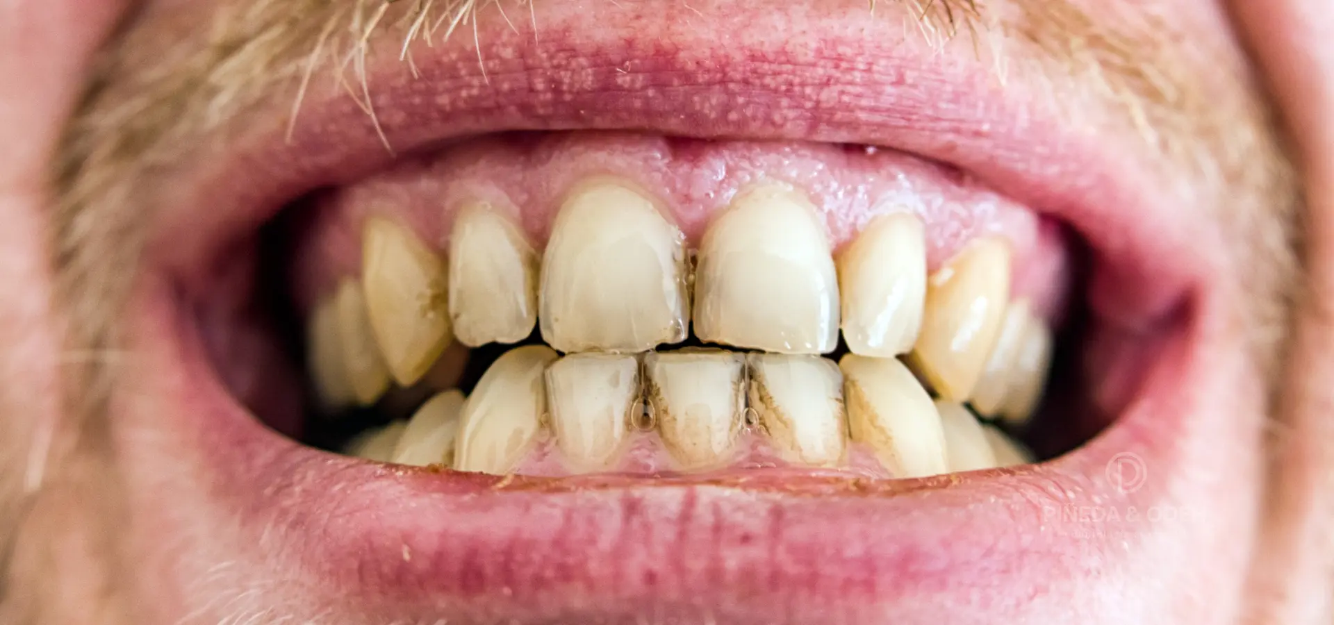 Manchas dentales visibles en los dientes causadas por acumulación de placa y tinciones