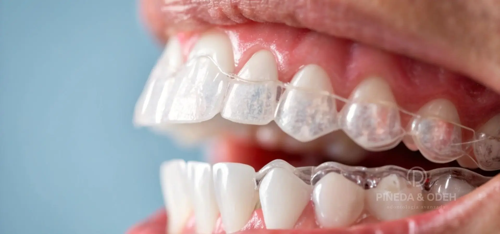 Ortodoncia invisible para corregir apinamiento dental leve o moderado