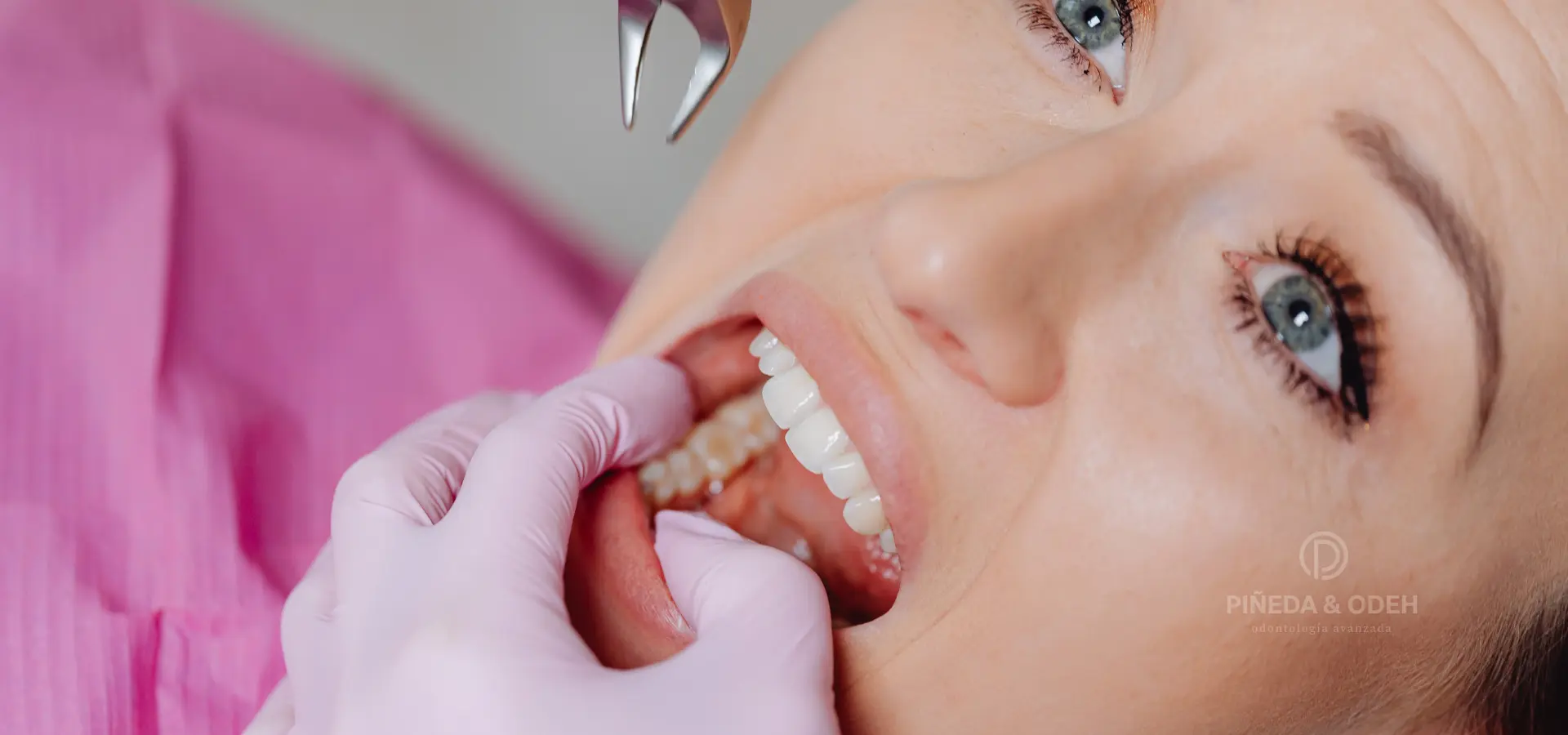 Extracción de muela del juicio realizada en Clinica Pinea&Odeh