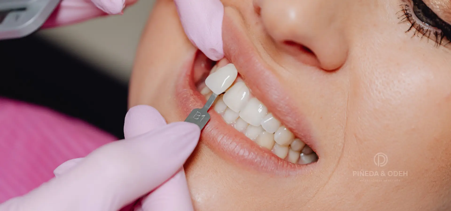 Reconstrucción estética dental