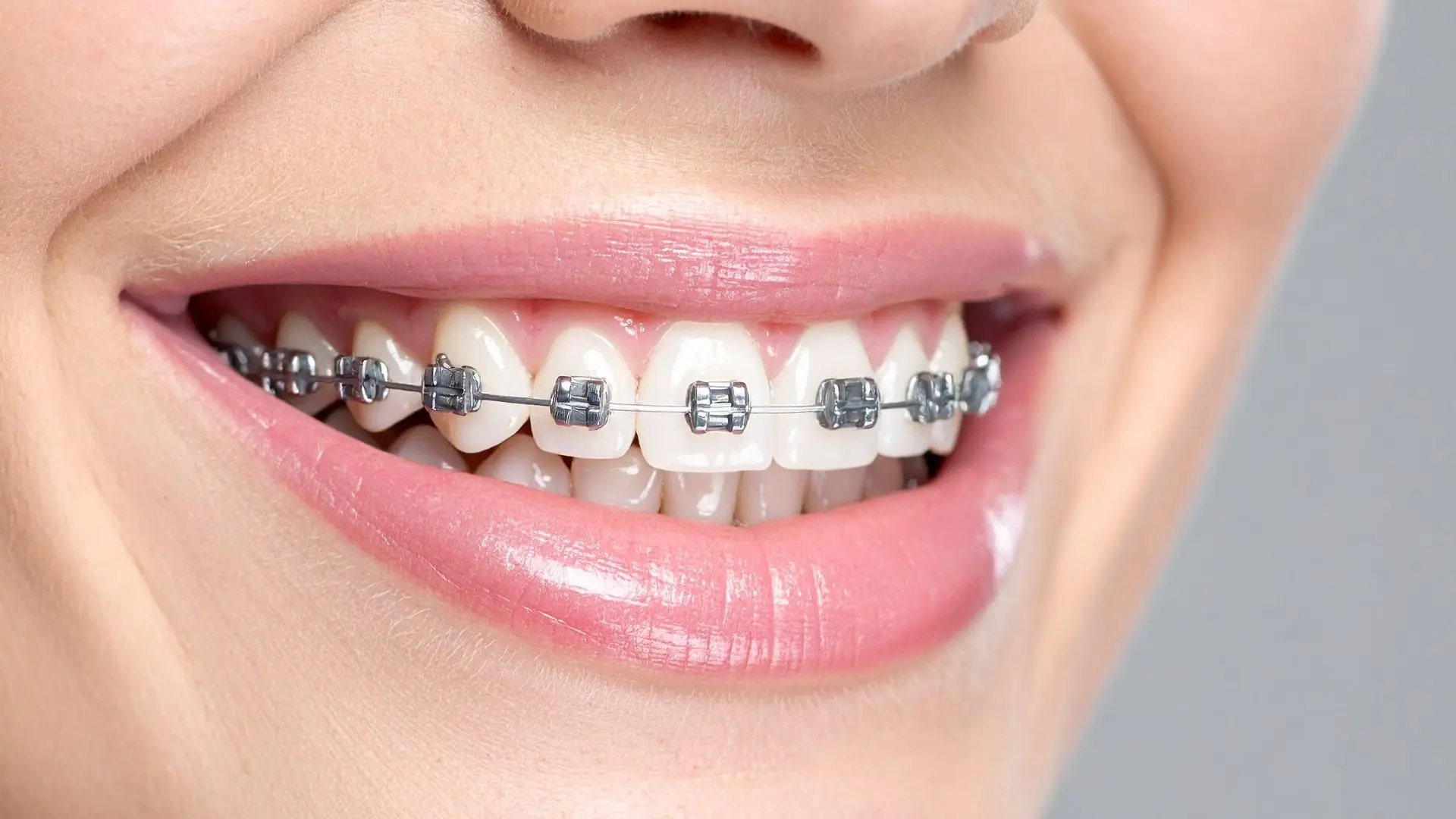 Brackets metálicos convencionales en Alcobendas LCinica Pineda&Odeh