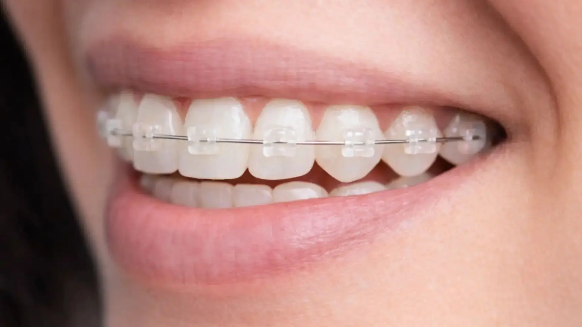 Clinica Pineda & Odeh Brackets de cerámica