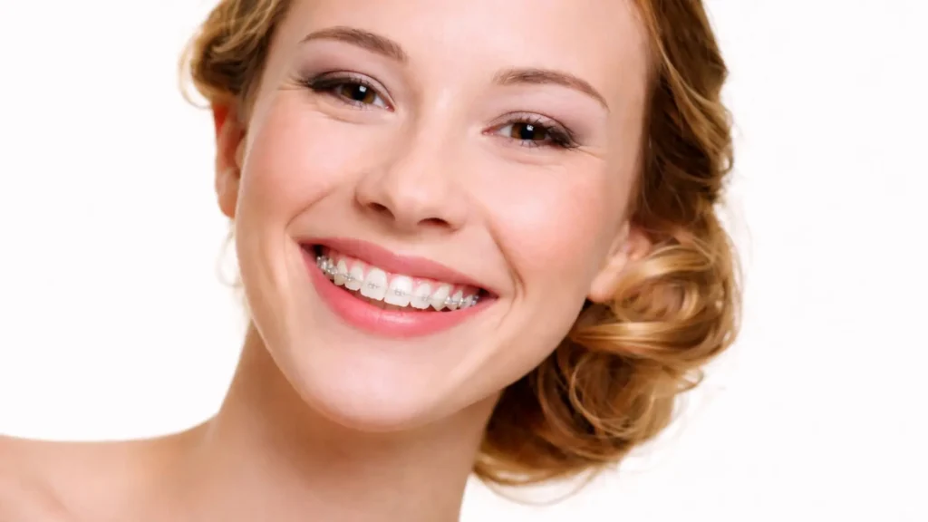 clinica Pineda¬Odeh Brackets estéticos