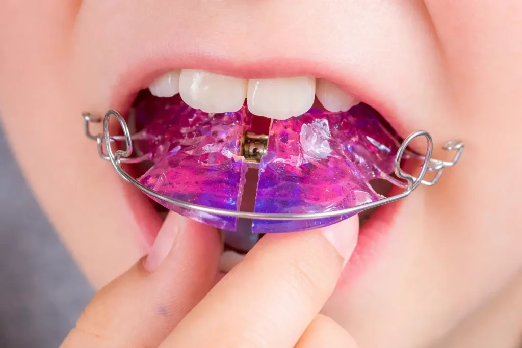 clinica-pineda-odeh-ortodoncia-interceptiva