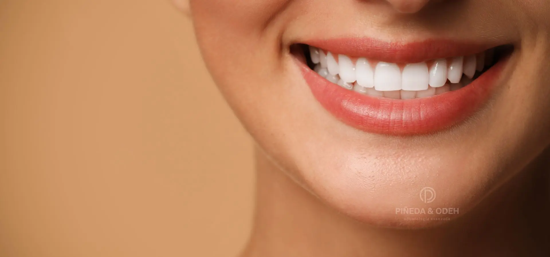 Carillas Dentales en Alcobendas Clinica Piñeda&Odeh