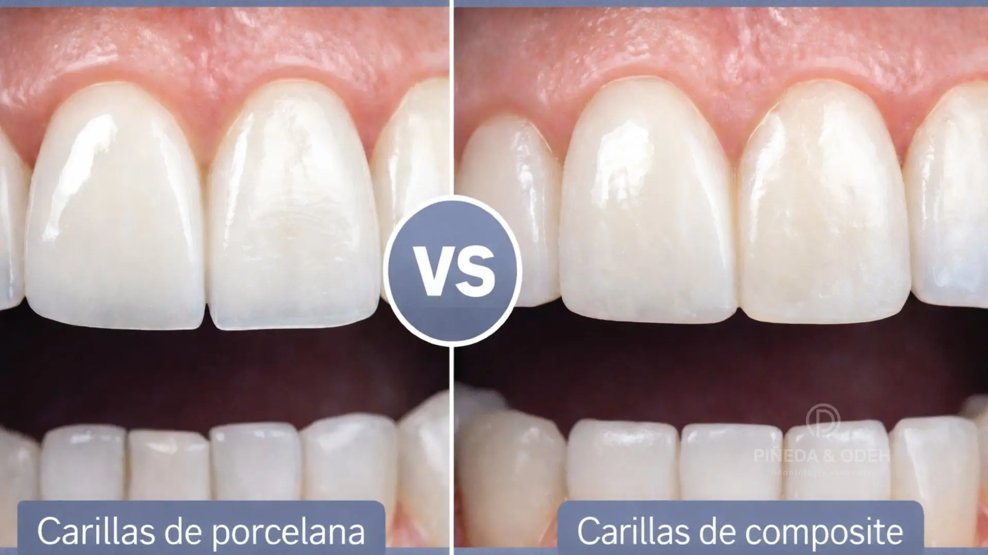 Carillas de porcelana vs Carillas de composite en Clínica Pineda&Odeh Alcobendas