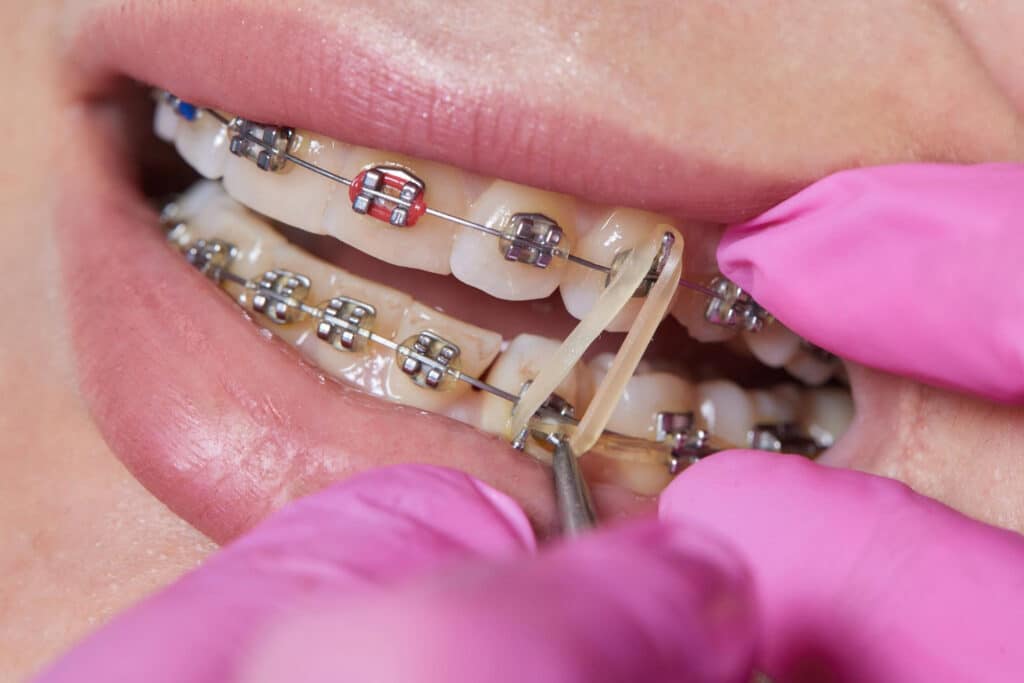 gomas que sirven como ligaduras para brackets
