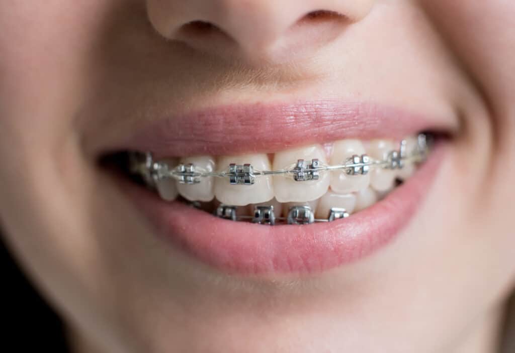 niño con brackets