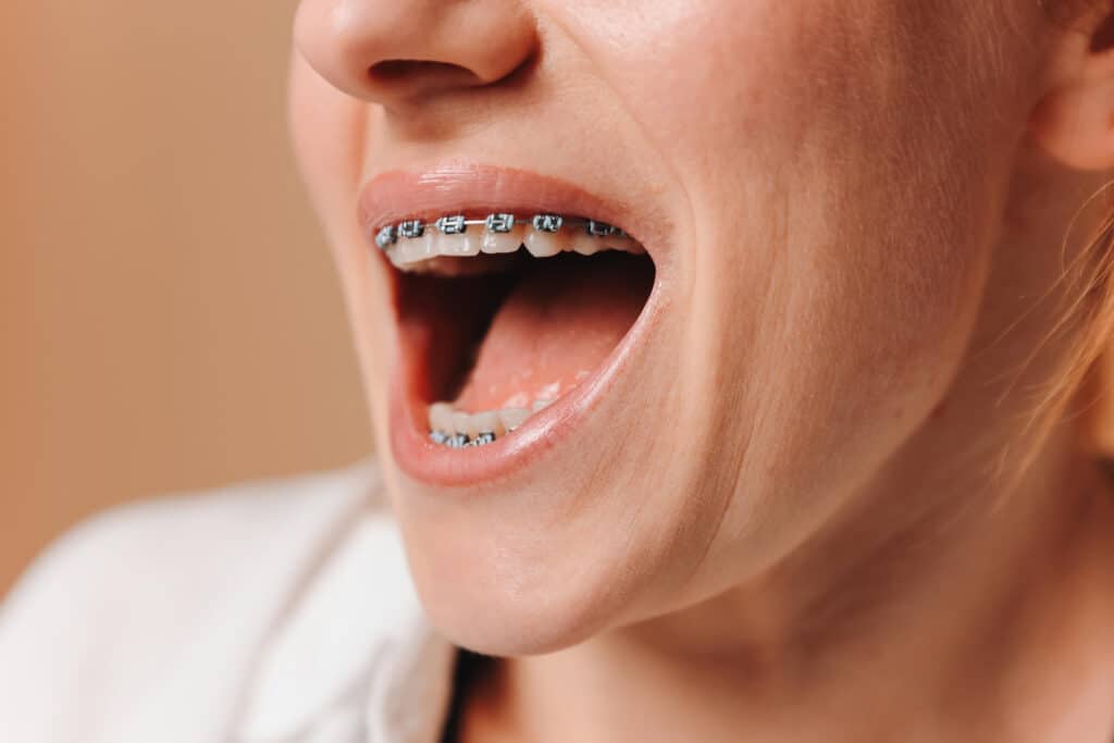 como aliviar las molestias de los brackets