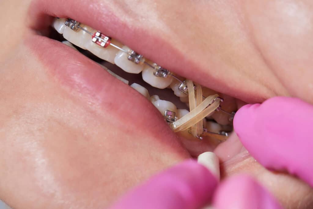 usar gomas de los brackets