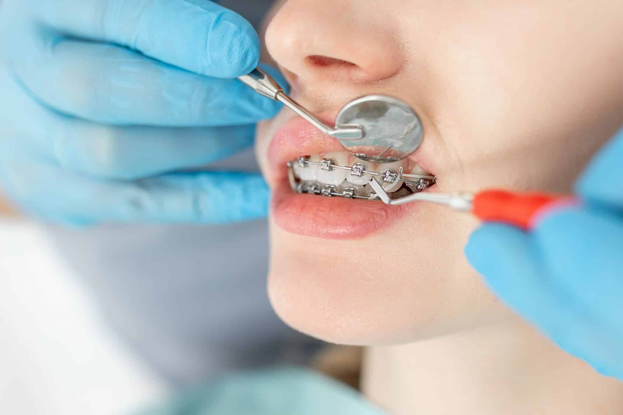 imagen de paciente de ortodoncia quirurgica haciendo una revision en la clinica dental piñeda y odeh de alcobendas