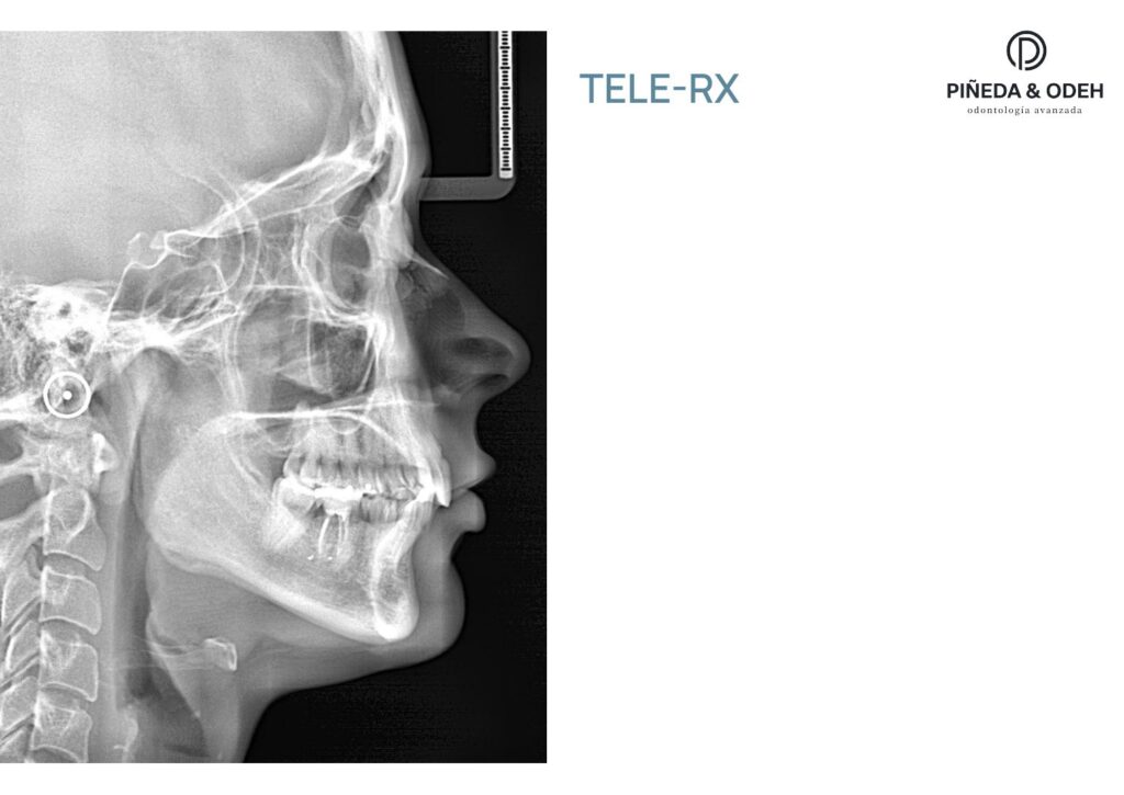 Telerradiografía lateral incluida en el informe de la primera visita