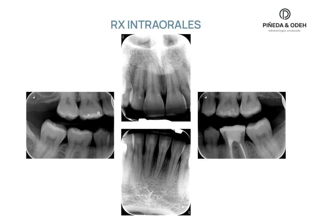 Radiografías intraorales incluidas en el informe de la primera visita